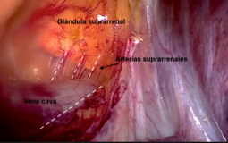 Adrenalectomía laparoscópica de adenoma funcionante y feocromocitoma de gran tamaño