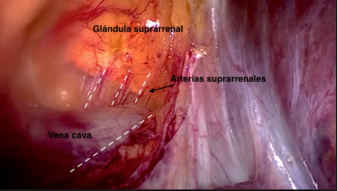 Adrenalectomía laparoscópica de adenoma funcionante y feocromocitoma de gran tamaño