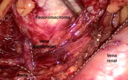Adrenalectomía laparoscópica por Feocromocitoma