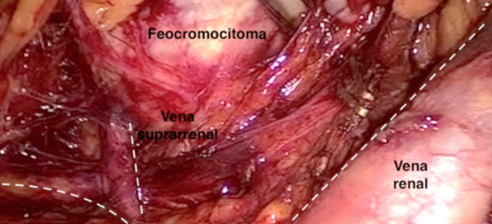 Adrenalectomía laparoscópica por Feocromocitoma