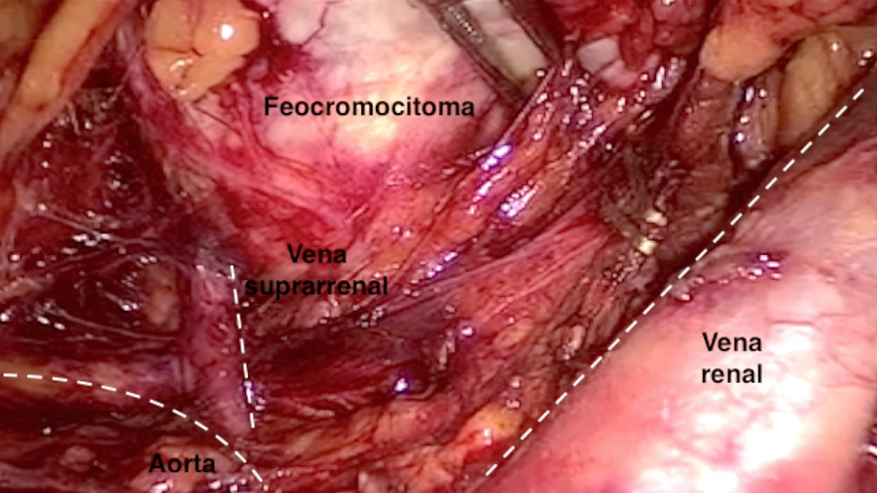 Adrenalectomía laparoscópica por Feocromocitoma