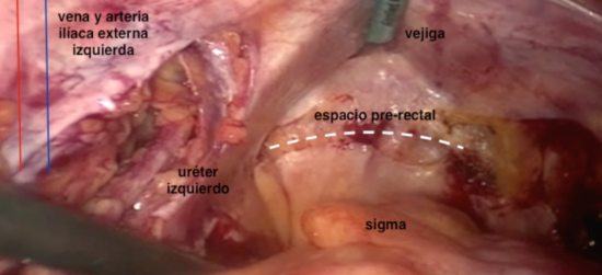 Cistectomía radical laparoscópica