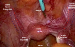 Cistectomía laparoscópica con preservación vaginal
