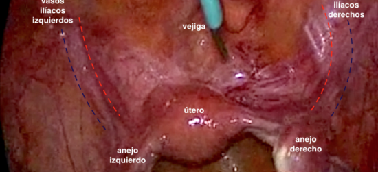 Cistectomía laparoscópica con preservación vaginal