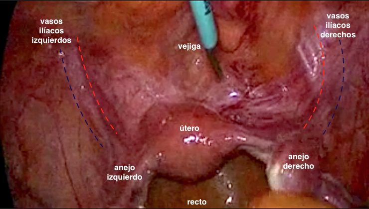 Cistectomía laparoscópica con preservación vaginal