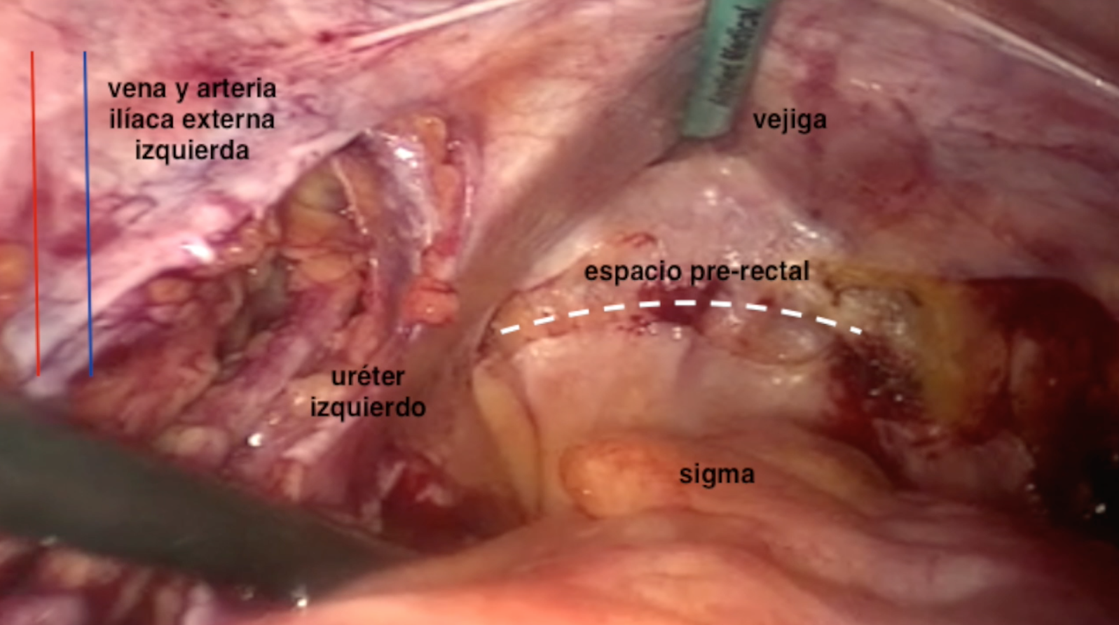Cistectomía radical laparoscópica