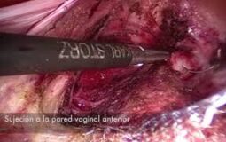 Colposacropexia laparoscópica