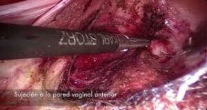 Colposacropexia laparoscópica