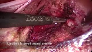 Colposacropexia laparoscópica