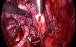 Prostatectomía radical laparoscópica e hidrodisección