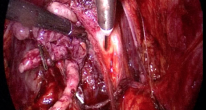 Prostatectomía radical laparoscópica e hidrodisección