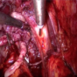 Prostatectomía radical laparoscópica e hidrodisección