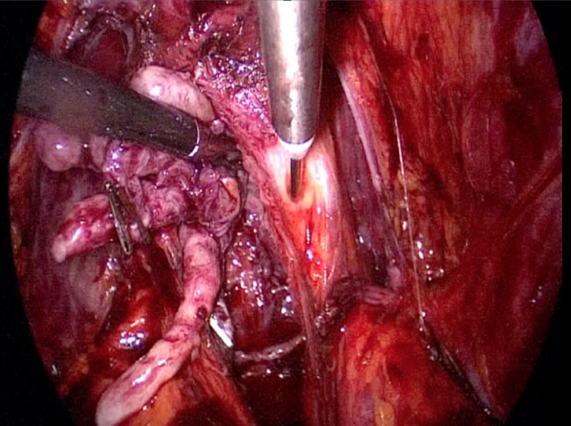 Prostatectomía radical laparoscópica e hidrodisección