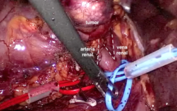 Nefrectomía parcial laparoscópica de tumores complejos en hilio renal