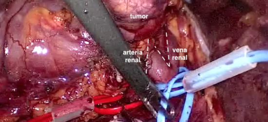 Nefrectomía parcial laparoscópica de tumores complejos en hilio renal