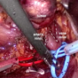 Nefrectomía parcial laparoscópica de tumores complejos en hilio renal