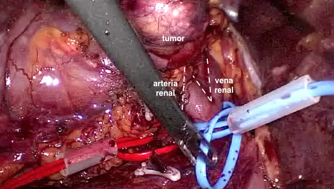 Nefrectomía parcial laparoscópica de tumores complejos en hilio renal