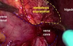 Suprarrenalectomía bilateral laparoscópica por metástasis de carcinoma urotelial
