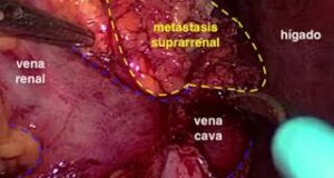 Suprarrenalectomía bilateral laparoscópica por metástasis de carcinoma urotelial