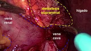 Suprarrenalectomía bilateral laparoscópica por metástasis de carcinoma urotelial