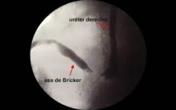 Aplicación de la ureterorrenoscopia en la patología no litiásica